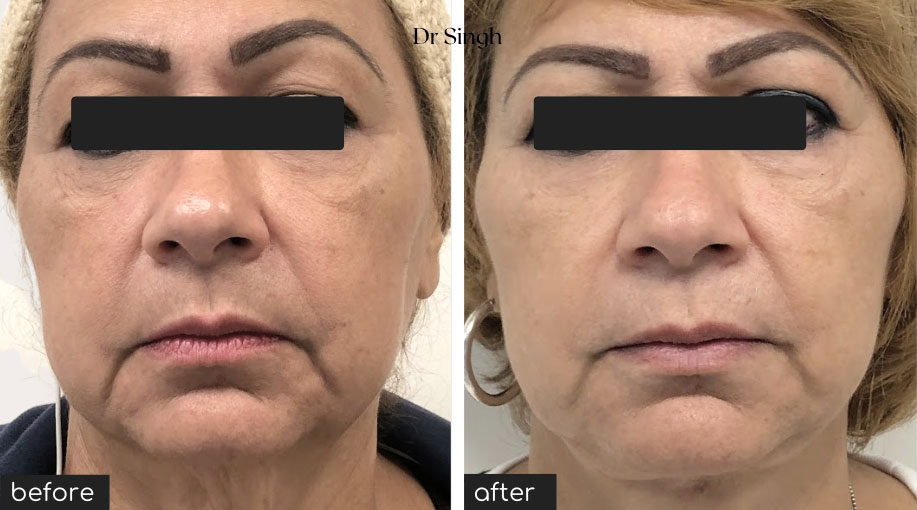 before after mini face lift nyc